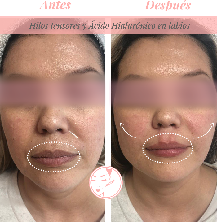 Hilos-tensores-Y-áciso-hialurónico-en-labios
