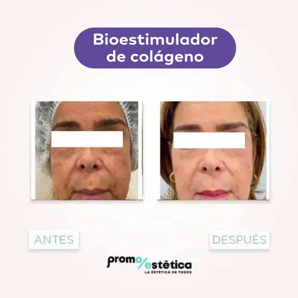 bioestimulador de colageno testimonio