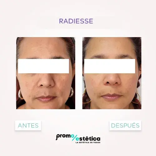 radiesse testimonio home