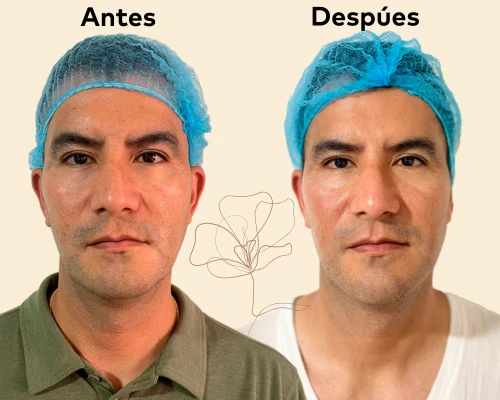 Antes y despúes del primer tratamiento con Sunekos en Promoestética